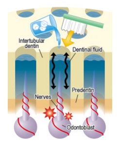 Гидродинамическая теория, представленная в 1964 г. M. Brannstrom и A. Astron, предполагает, что повреждение эмали и/или цемента в пришеечной области может привести к обнажению дентинных канальцев из-за определенных раздражителей. Это воздействие может вызвать движение дентинной жидкости внутри дентинных канальцев, что косвенно стимулирует нервные окончания пульпы, что приводит к боли. Большое изменение давления также может вызвать усиливающийся поток жидкости, который может генерировать электрический нервный импульс. Следовательно, люди с чувствительным дентином могут испытывать острые болевые ощущения во время или после воздействия раздражителя.