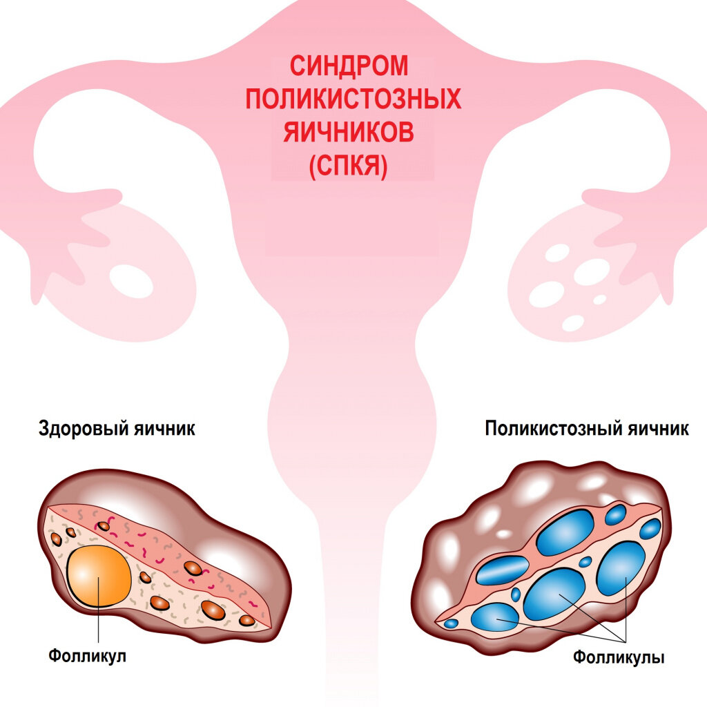 Поликистоз яичников картинки