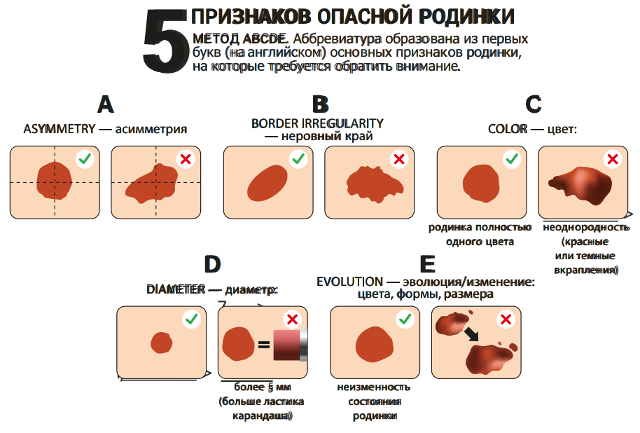 Как выглядят плохие, опасные родинки?