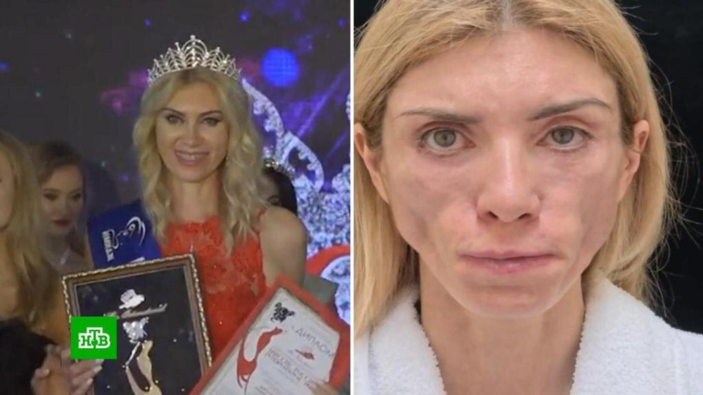    «Я потеряла свою красоту»: женщина не может закрыть глаза после круговой подтяжки лица