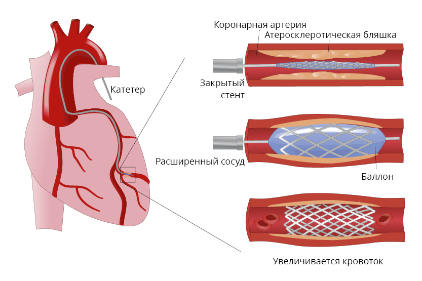 После стентирования