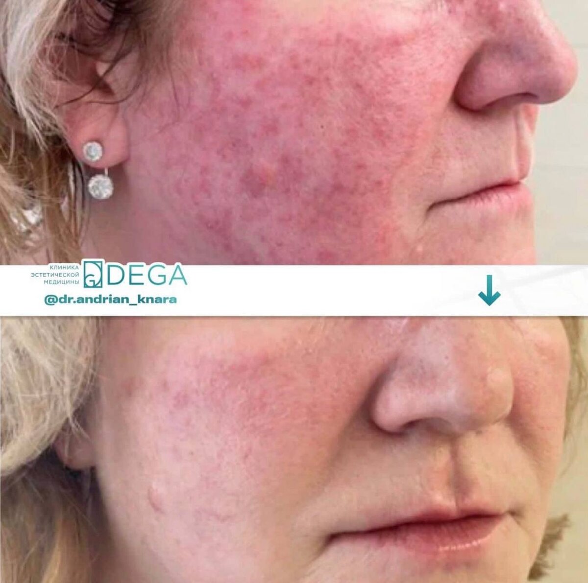 Промежуточный результат фототерапии от врача-косметолога Кнары Викторовны Андрян
