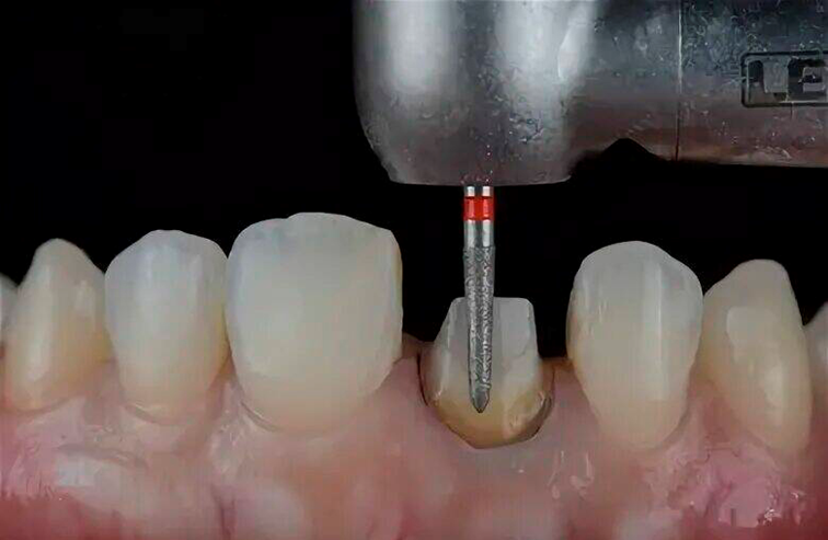 обточка зубов