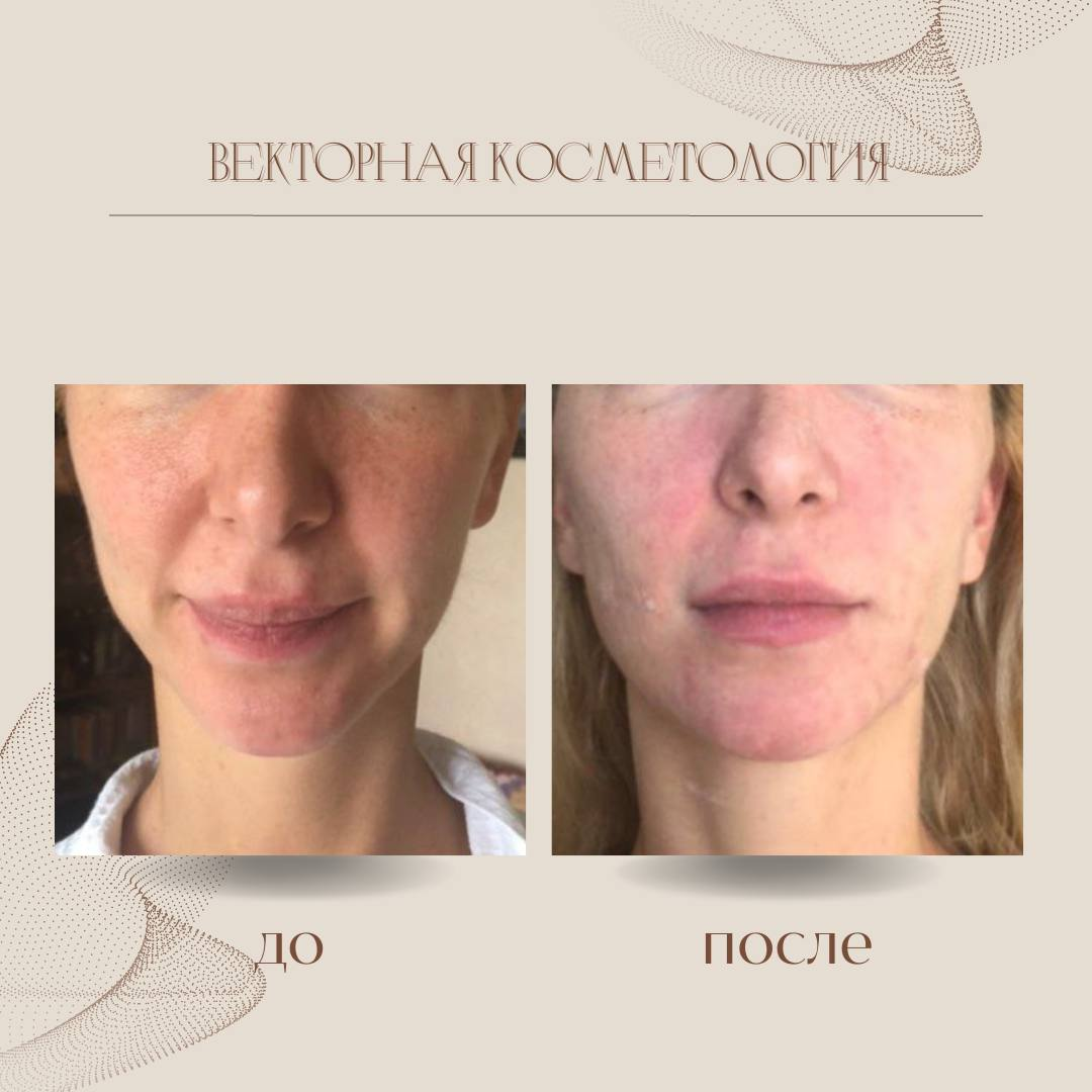 Результат после курса Векторного массажа