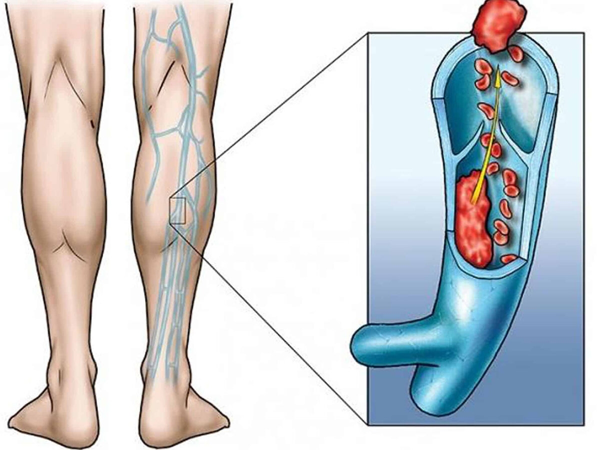 Как выглядит тромб вен. Тромбоз и тромбофлебит глубоких вен. Тромбоз икроножных вен. Острый венозный тромбоз нижних конечностей. Тромбофлебит подкожных вен.