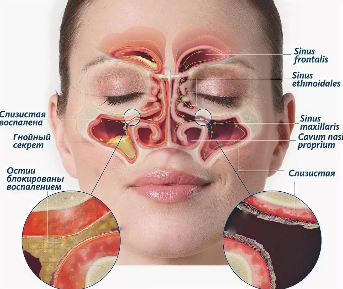 Где скапливаются сопли в носу схема
