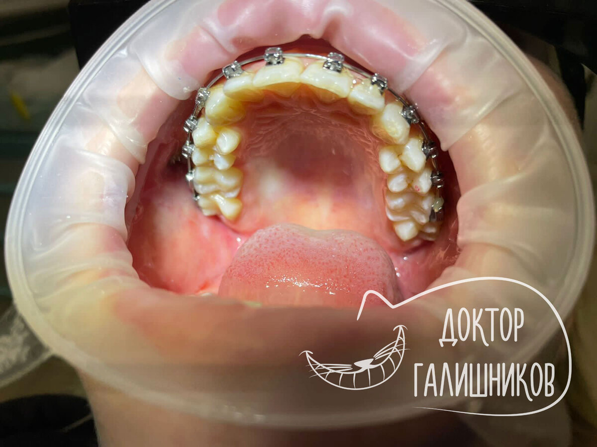 Как быть с кариесом во время ортодонтического лечения | Галишников Олег ...