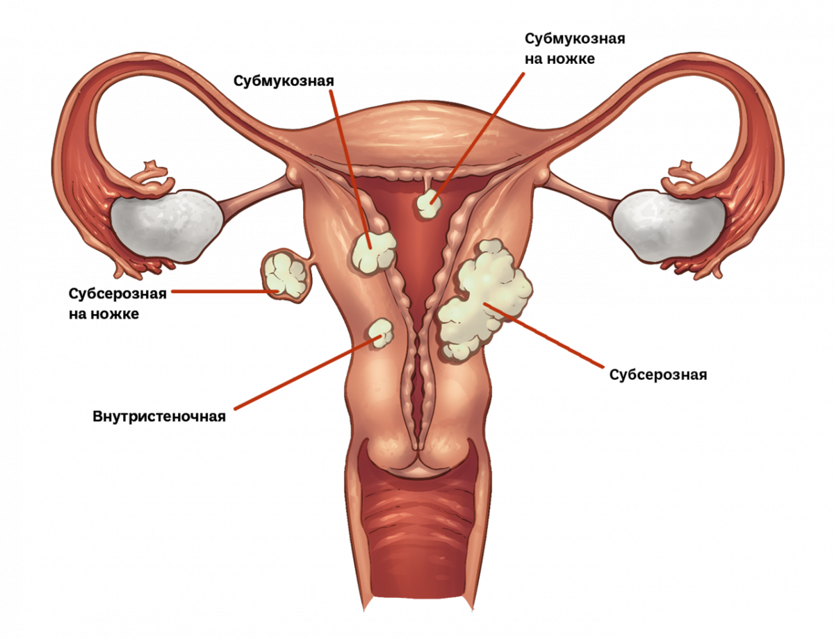 Миома матки что это такое. Миома матки классификация Figo. Расположение миоматозных узлов.