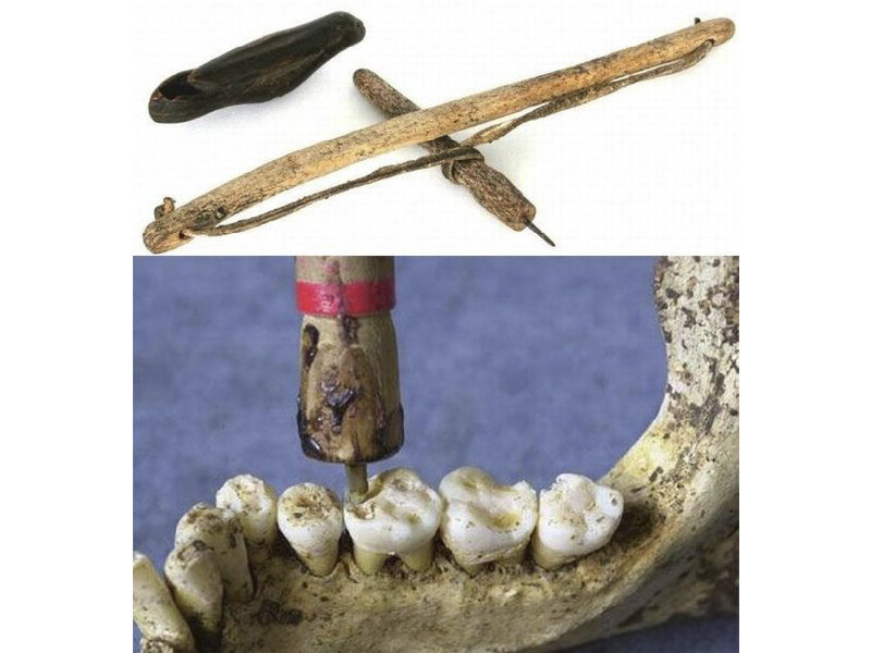 Лучковая дрель, которой сверлил отверстия в зубах для установки пломб. Другие варианты устройства =>