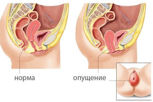 Уменьшение влагалища (Vaginoplasly)