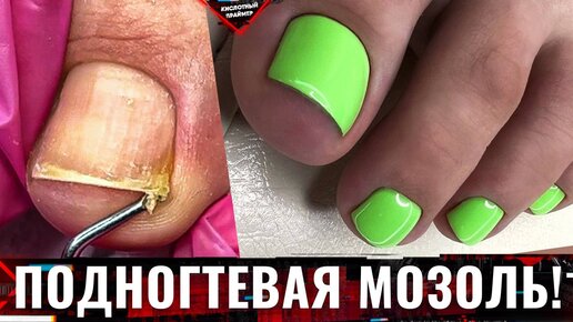 Подногтевая мозоль фото