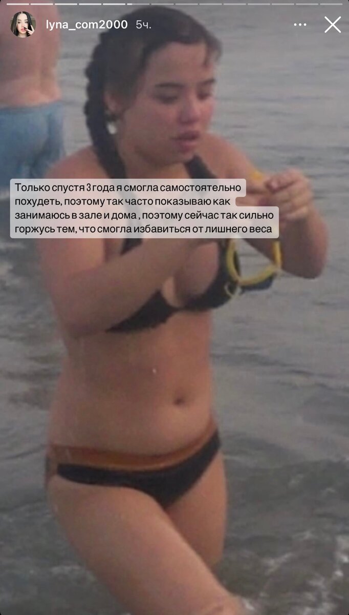   Архивное фото Лунаком после гормонального сбоя Фото: Инстаграм (запрещен в РФ) @lyna_com2000