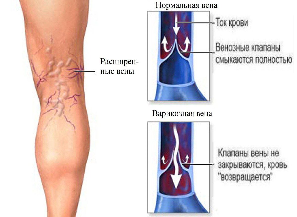 Боли при варикозном расширении. Варикозное заболевания расширение вен нижних конечностей. Варикозное расширение вен патанатомия.