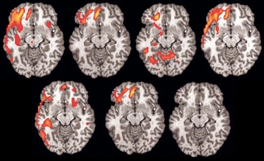 Нейробиологи из Швейцарии просканировали мозг 13 взрослых людей и обнаружили, что звуки положительно окрашенного голоса вызывают сильную нейронную активность и положительные эмоции, когда они слышны именно с левой стороны.Сейчас ученые выясняют для чего нашему мозгу такое разделение.