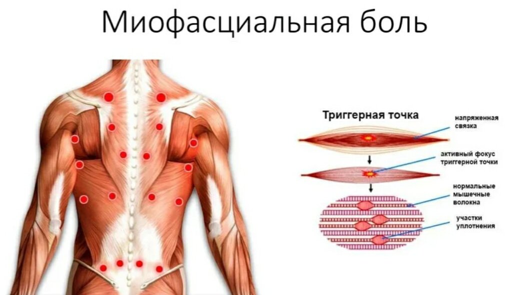 Защемило нерв в грудном отделе: что делать