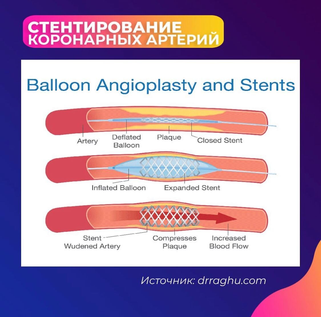 Стентирование