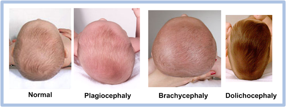Деформация головы у ребенка