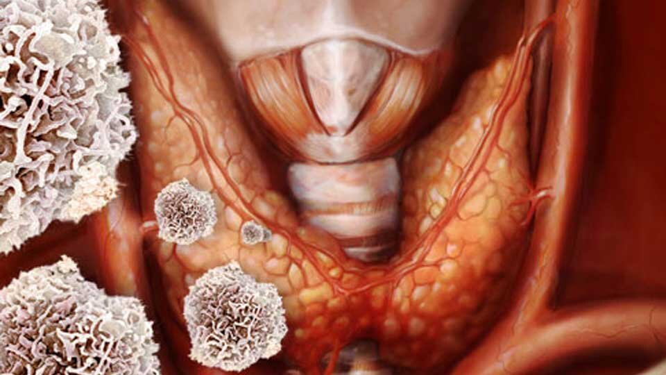 Иммунная система начинает атаковать щитовидную железу