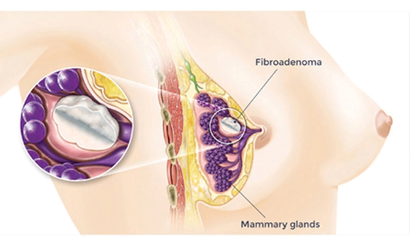 Молочные железы фиброаденома что. Фиброаденома молочной груди. Фиброаденома молочных желез мкб 10.