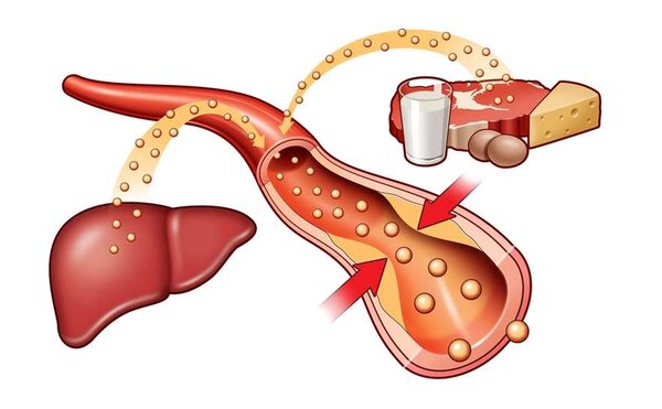 Правда ли жир и холестерин забивают наши сосуды бляшками?
