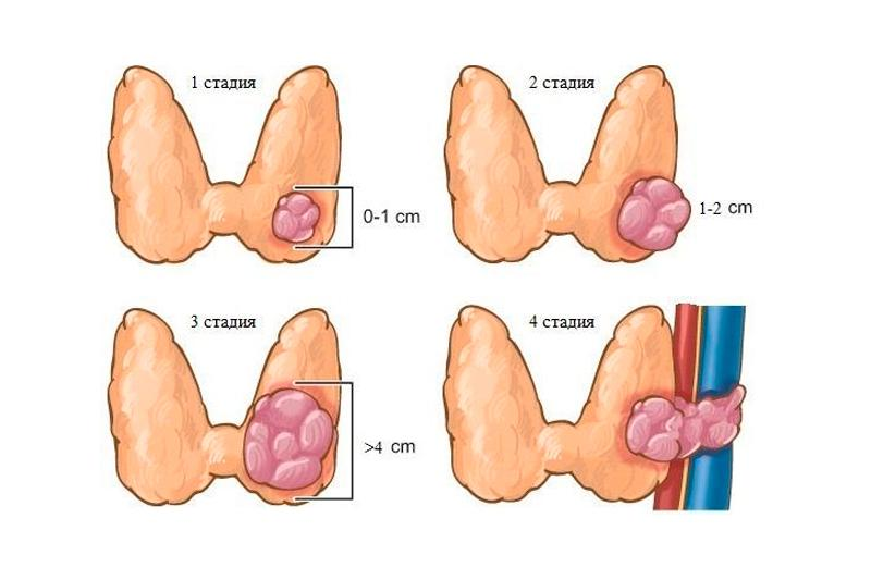 Злокачественная опухоль щитовидной. Опухоль щитовиднойсжелезы. Карцинома щитовидной железы.