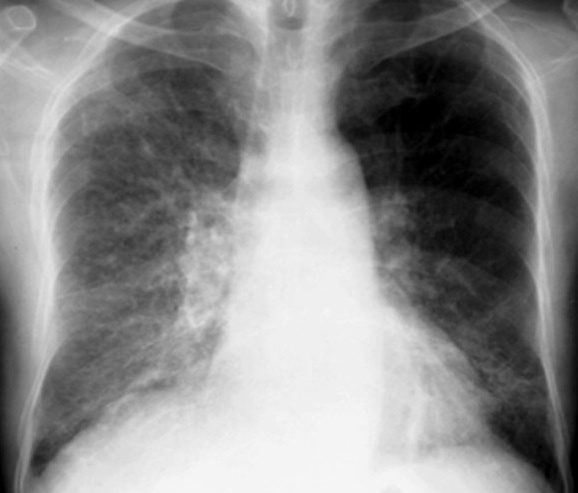 Признаки диффузного фиброза лёгких на рентгенограмме
