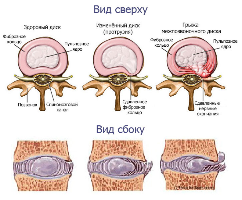 Медианно парамедианная билатеральная. Грыжи и протрузии позвоночника. Протрузия дисков позвоночника что это такое. Протрузия дисков позвоночника и грыжа. Грыжа диска и протрузия диска.