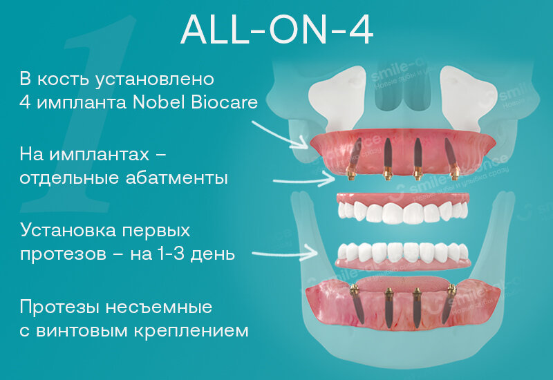 Так выглядит имплантация all-on-4, или все зубы на 4 имплантах. Фотоколлаж: Smile-at-Once.ru.