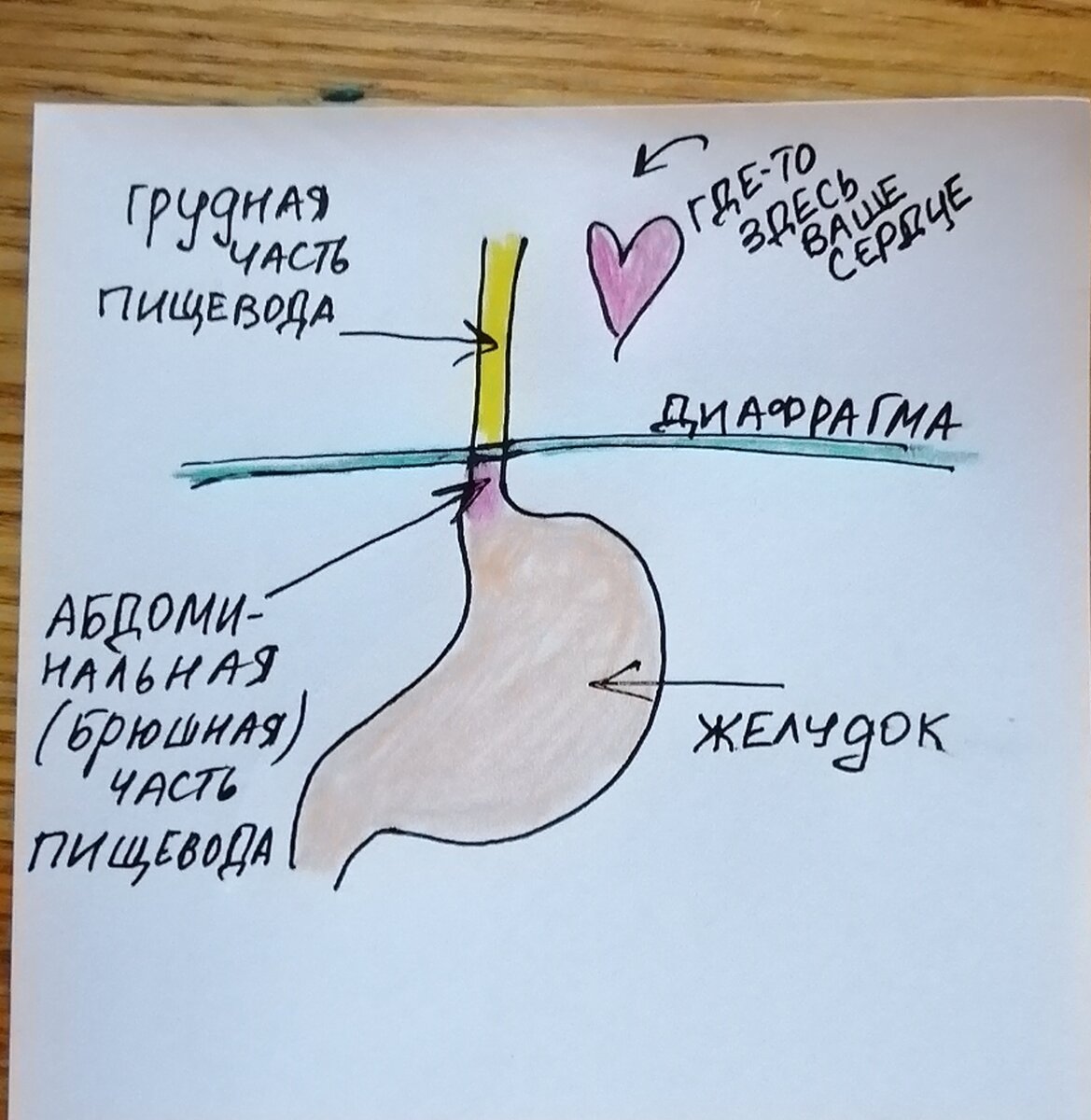 Грыжа пищеводного отверстия диафрагмы. | Страничка гастроэнтеролога | Дзен