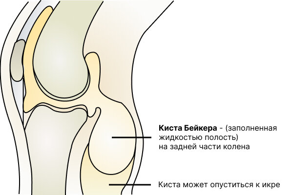 Киста подколенной ямки коленного сустава. Как выглядит киста коленного сустава КСС. Бейкера киста. Кистоподобные поражения вокруг коленного сустава. Triceps femoris muscle