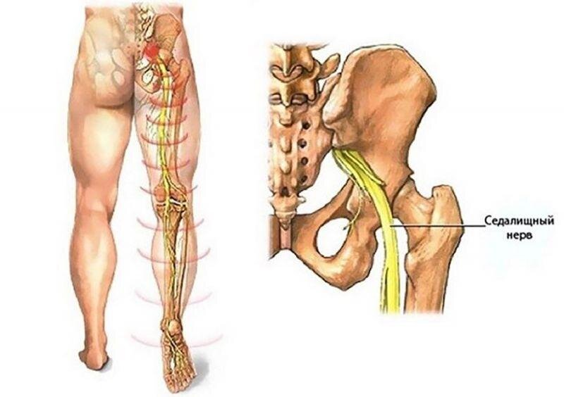 Седалищный нерв боль в ноге и ягодице