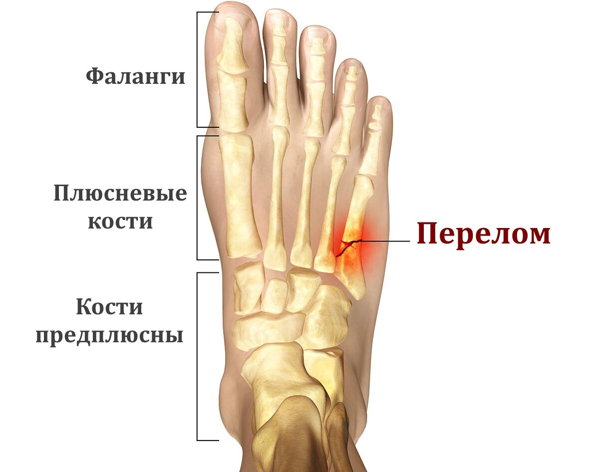 Лечение перелома плюсневой кости