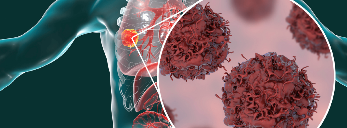 Онкология. Онкологическая опухоль. Онкологические заболевания легких.