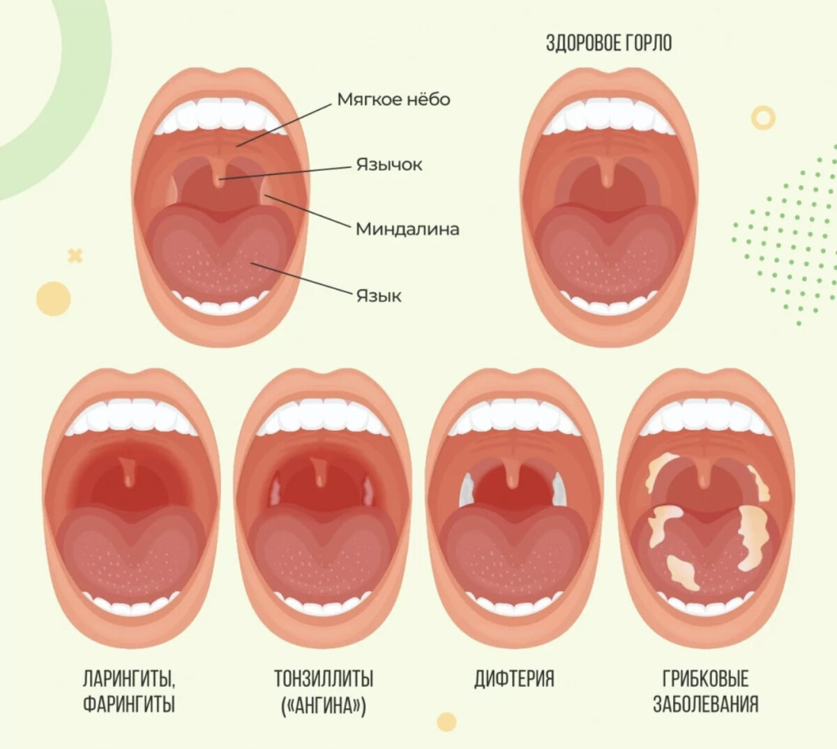 Педіатр Плюс :: Для батьків :: Воспаленное горло (sore throat) - фарингит, тонзиллит, ангина