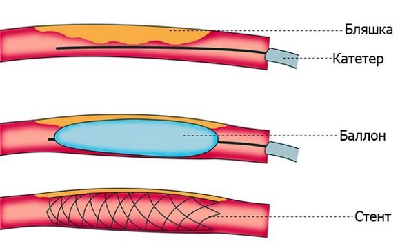 Транслюминальная баллонная ангиопластика. Баллонная ангиопластика и стентирование. Баллонная ангиопластика коронарных артерий. Ангиопластика сосудов нижних конечностей. Стентирование коронарных артерий схема.