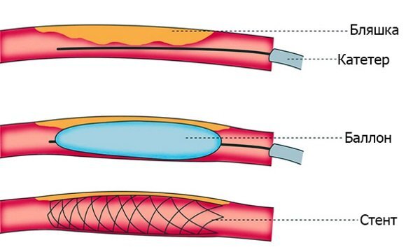Баллонная ангиопластика нижних. Баллонная ангиопластика и стентирование. Баллонная ангиопластика коронарных артерий. Ангиопластика сосудов нижних конечностей. Стентирование коронарных артерий схема.