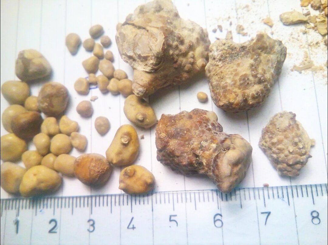 У кого есть или быда такая проблема, знают, какую боль причиняют эти каменюки! 