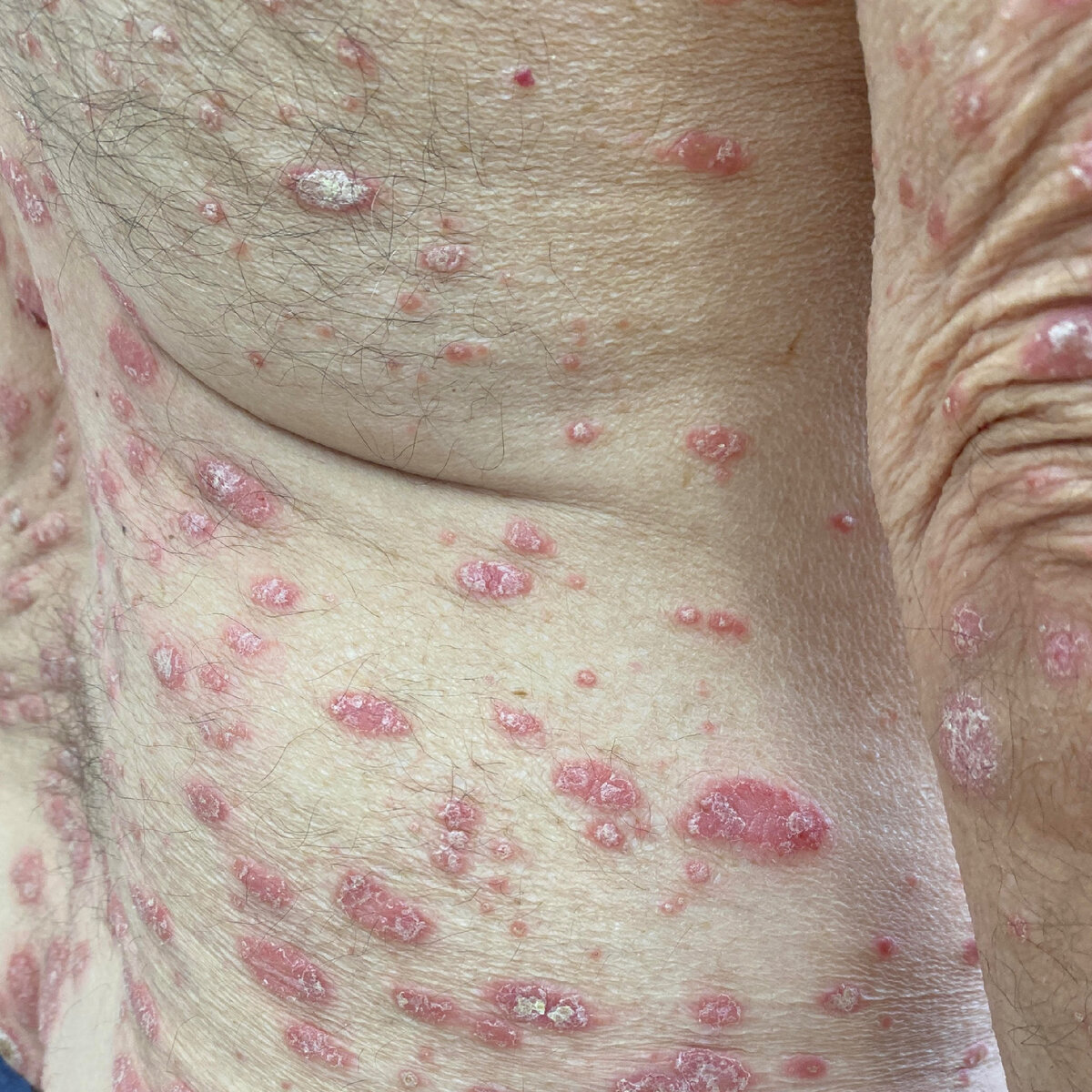 Распространенный псориаз