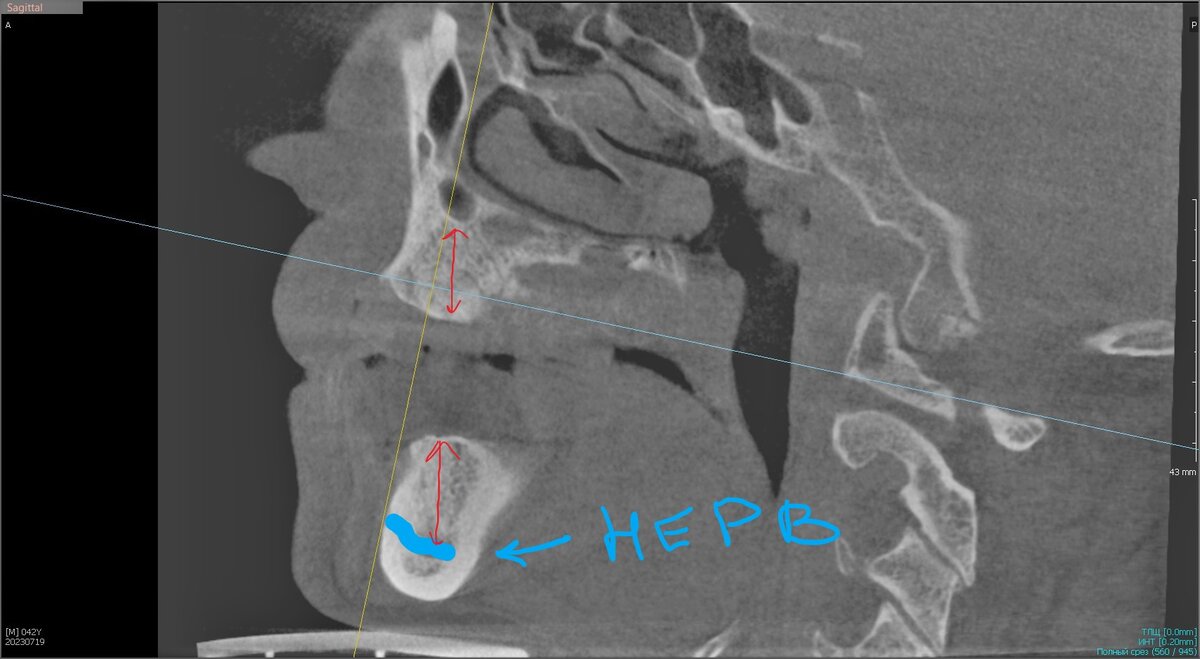 Кости достаточно.
