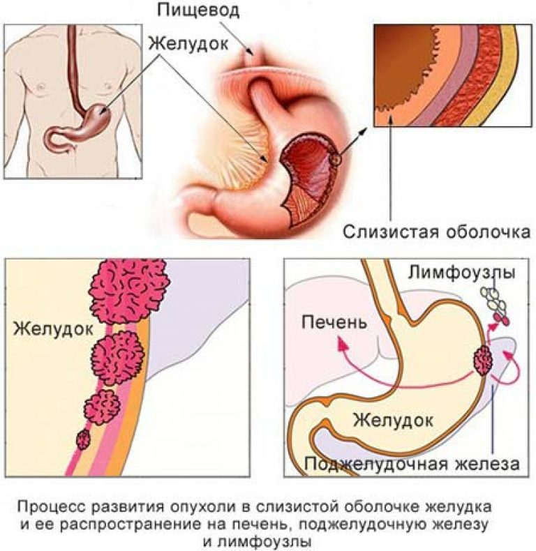 Как определить рак. Симптомы онкологии желудка у женщин на ранних стадиях. Карцинома желудка симптомы. Раковая опухоль желудка. Опухоль желудка симптомы