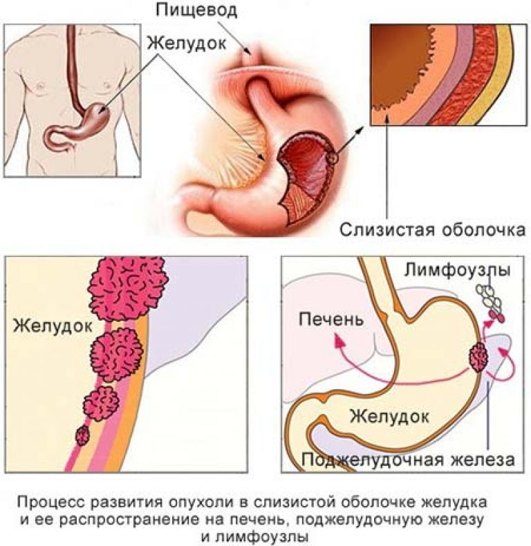 Симптомы онкологии желудка. Симптомы онкологии желудка у женщин на ранних стадиях. Карцинома желудка симптомы. Раковая опухоль желудка. Опухоль желудка симптомы.