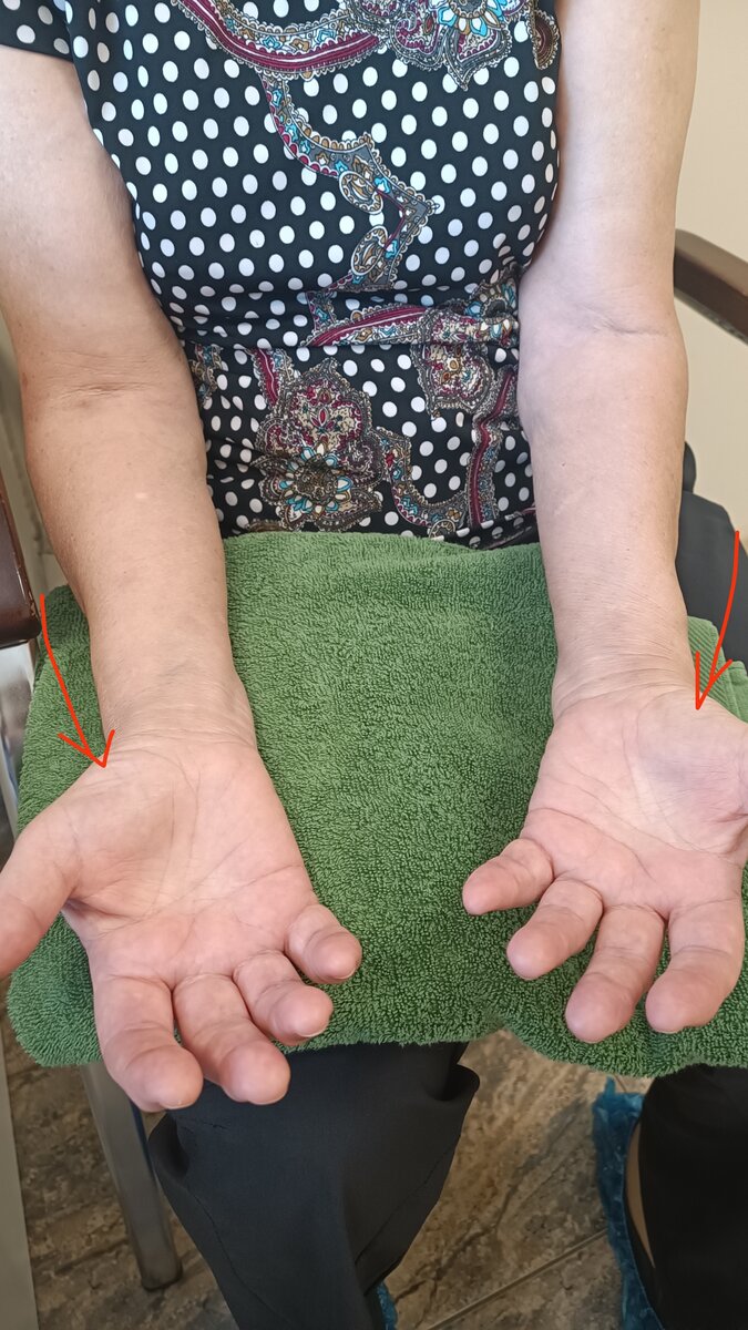 Женщина жалуется, что на руках появились  ,,ямы"