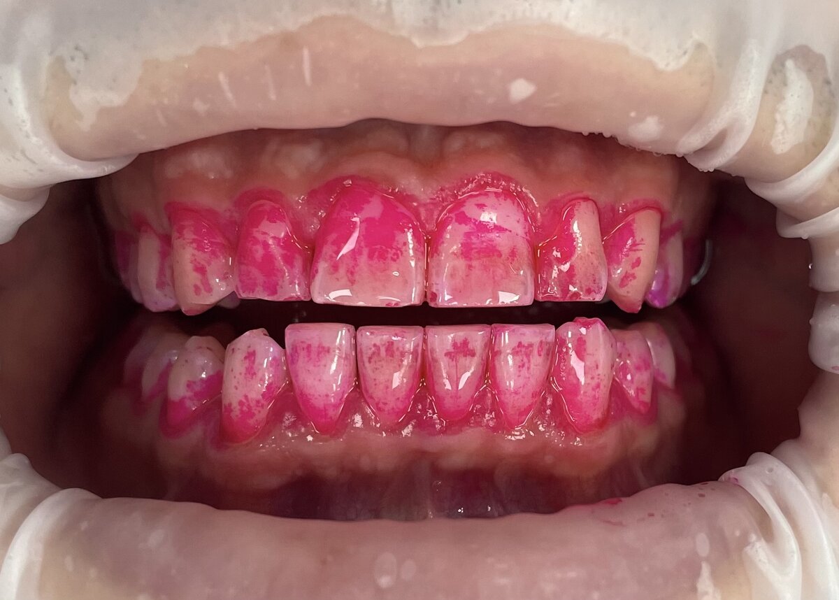 Индикация зубного налёта. 