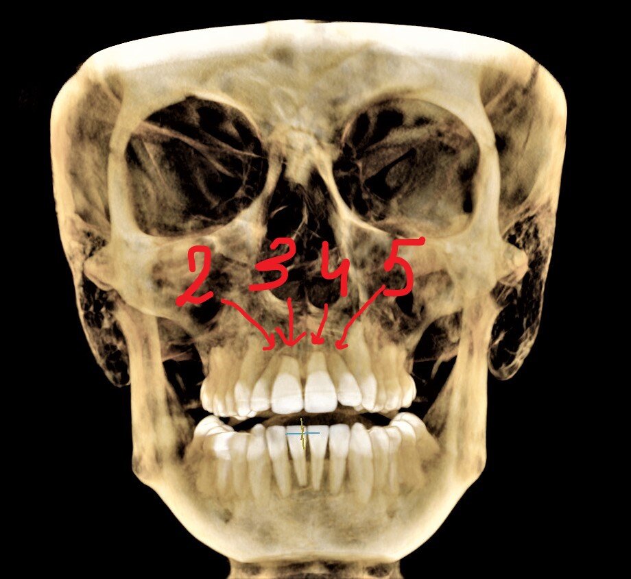 Симптомы кариеса корня зуба