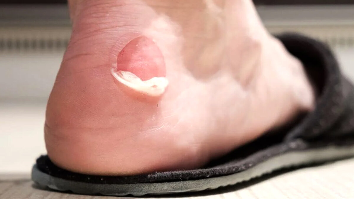 Мозоль. Фото 1