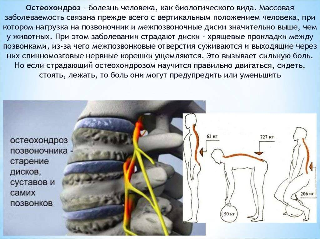 Еду всюду кочки вылетают позвоночки. Остеохондроз. Остеохондроз позвоночника. Нагрузка на позвоночник. Заболевания позвоночника остеохондроз.