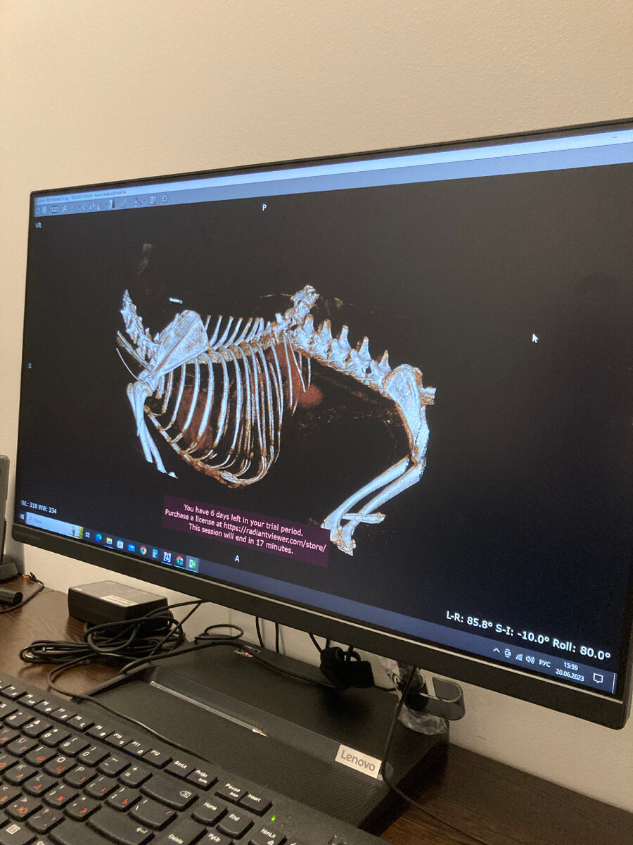 На КТ передом позвоночника со смещением.