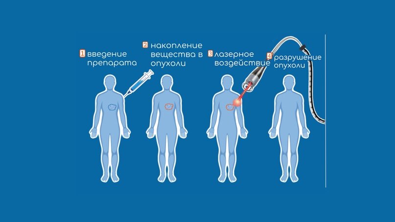 Как проходит лечение опухоли кожи с помощью Фотодинамической терапии?