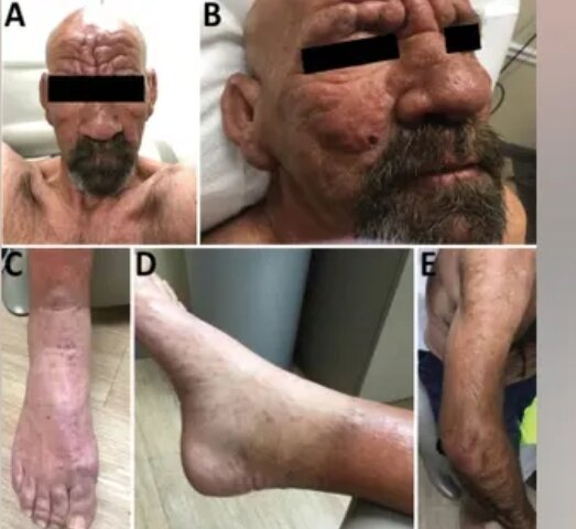 Авторы сообщили о лепроматозной проказе у одного мужчины из центральной Флориды , 54-летнего человека без факторов риска известных путей передачи. Лепроматозная проказа является одним из трех основных типов проказы, и у людей, инфицированных ею, появляются широко распространенные язвы и поражения. По данным клиники Кливленда, болезнь более заразна.