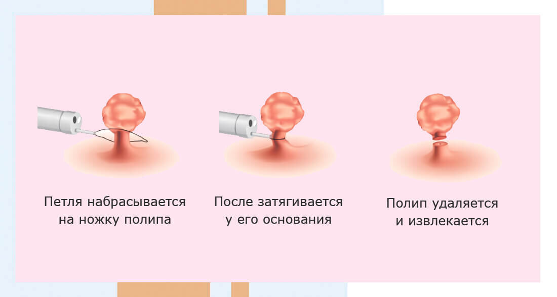 Резекция полипа с помощью микрохирургического скальпеля